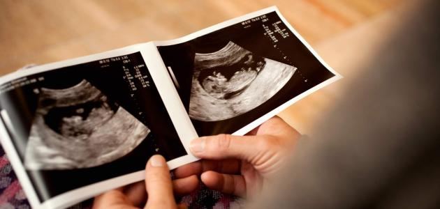متى يظهر نوع الجنين في السونار